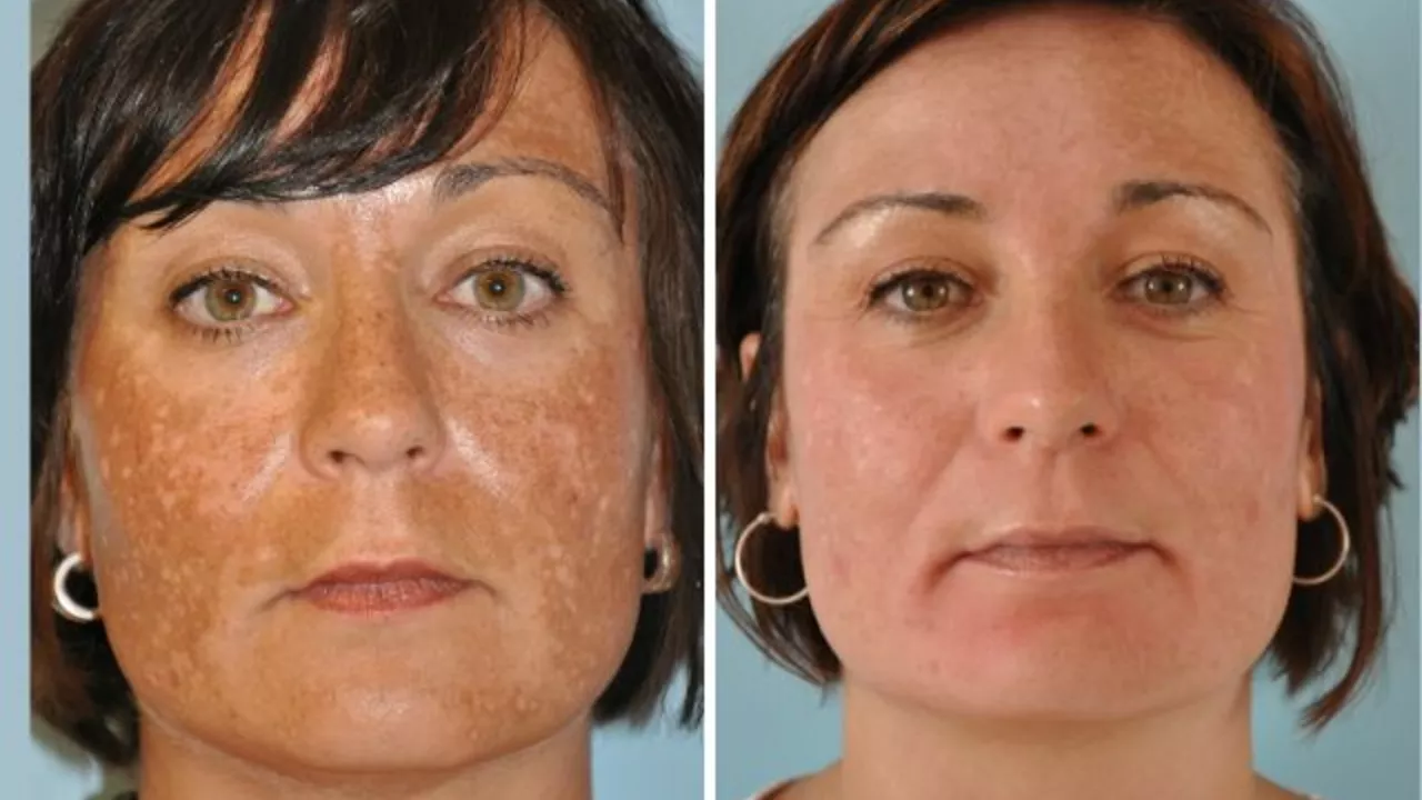 Chloasma and Aging: How to Reduce Skin Discoloration as You Age